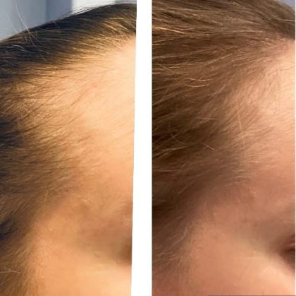 Bunee™ Corrector Capilar - cubre canas, poco pelo, alopecia y raices - 8 Tonos 🎁HOY 50%DCTO